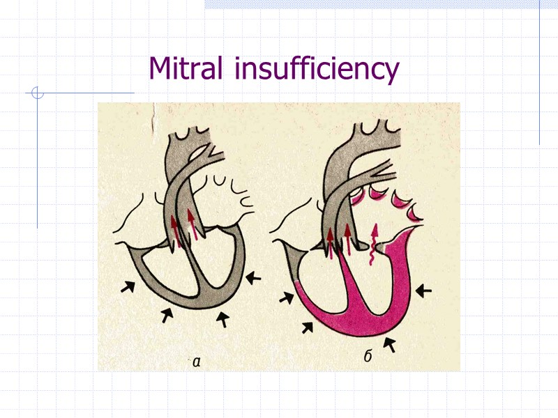 Mitral insufficiency
